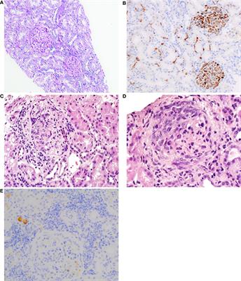 An unsuspected histopathological finding —concomitant IgA nephropathy in a patient with ANCA-associated vasculitis: a case report and literature review